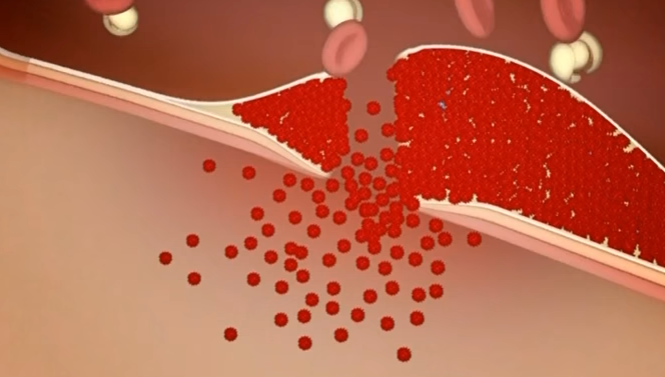 %e8%a1%80%e7%ae%a1%e7%a0%b4%e3%82%8c%e3%82%8b